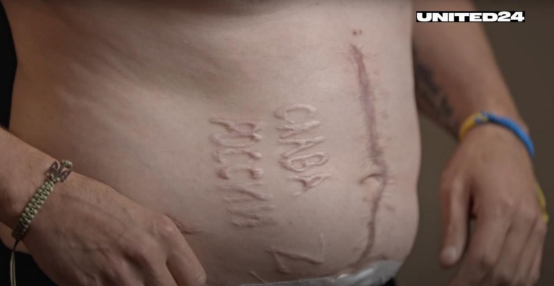 Investigative journalists ID surgeons who burned the inscription &ldquo;Glory to Russia&rdquo; onto the stomach of a Ukrainian POW